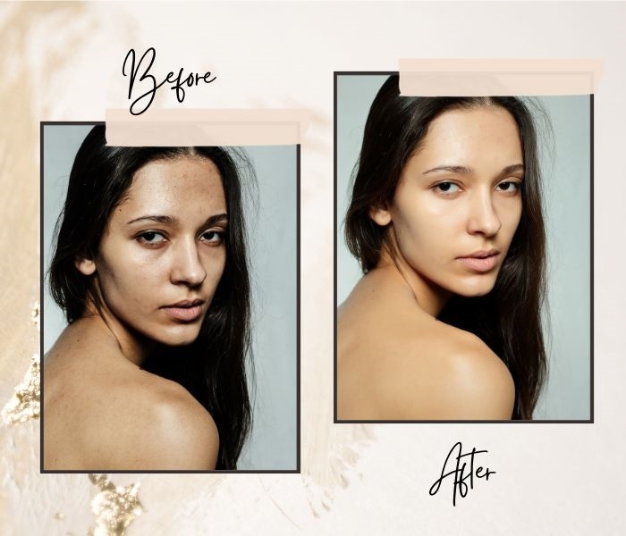 dBasic Acne Prone Skin Kit