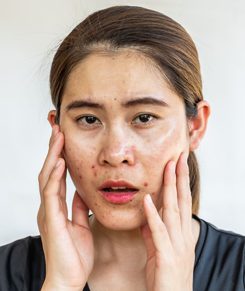 dBasic Oily Skin Kit