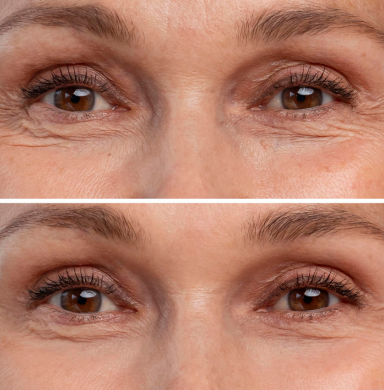 It works on Wrinkles