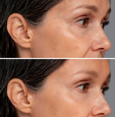 It works on Wrinkels and Aging