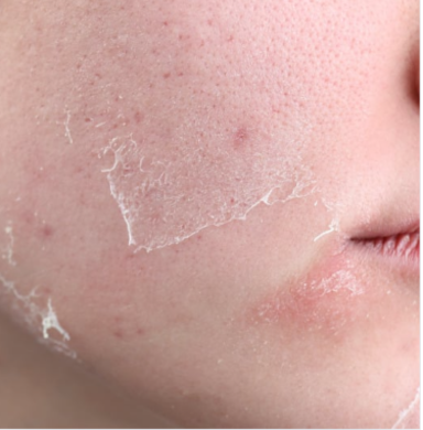 No more Dry skin
